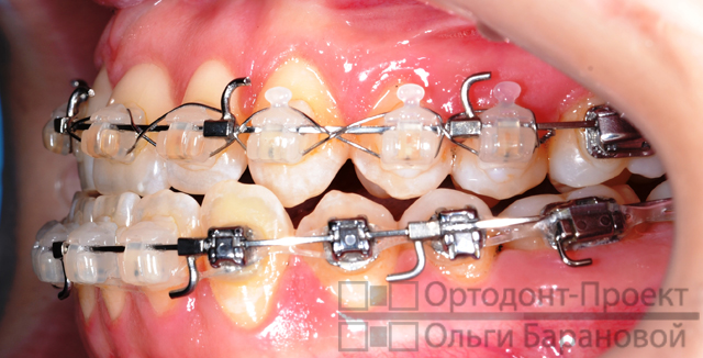 зубные ряды подготовлены к операции по исправлению прикуса