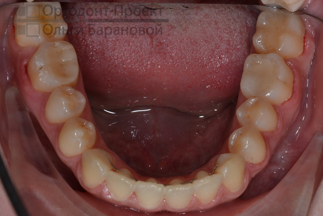 нижние зубы после хирургического исправления прикуса 