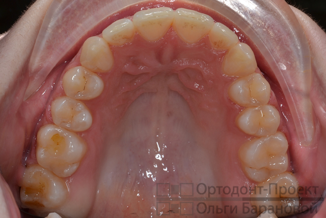 верхние зубы после хирургического исправления прикуса 