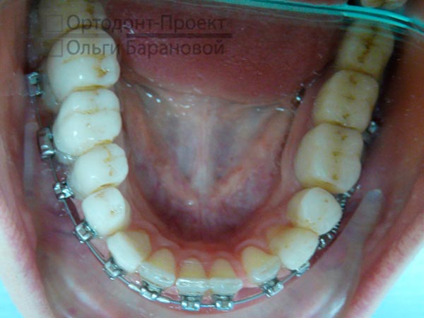 брекеты установлены на нижние зубы