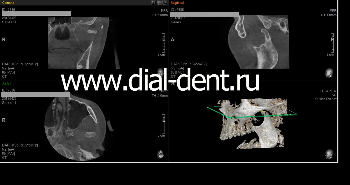 компьютерная томография левого ВНЧС с открытым ртом