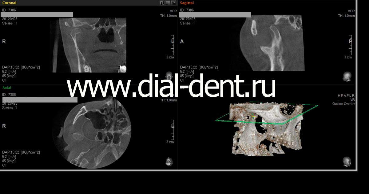 компьютерная томография правого ВНЧС с открытым ртом