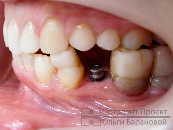 установлен зубной имплант