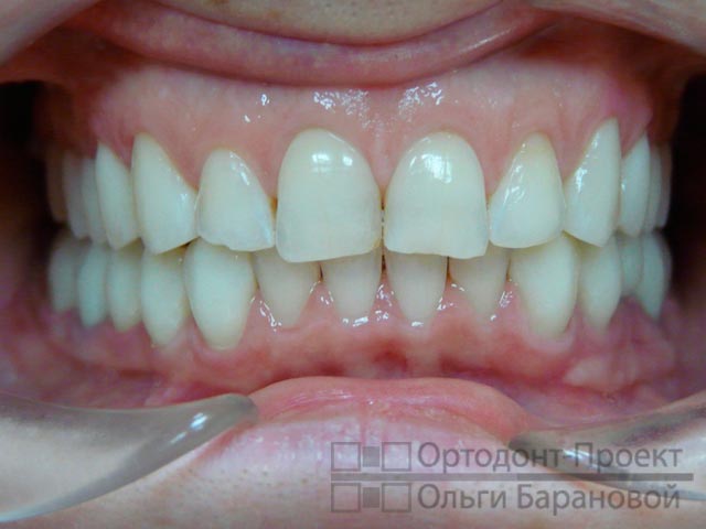 исправление прикуса, протезирование зубов