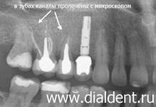 рентген после перелечивания каналов зубов с микроскопом