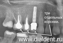 современный подход к протезированию зубов с установкой отдельных коронок на каждый зуб