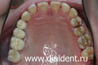 результат современного протезирования зубов керамикой, скол зуба закрыт вкладкой
