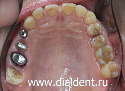 зубы подготовлены для установки коронок и вкладки, имплант прижился