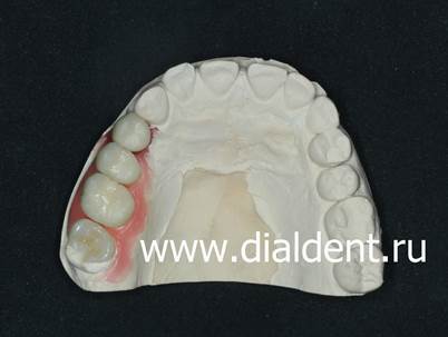 керамические коронки и керамическая вкладка в зуб на модели в лаборатории Диал-Дент