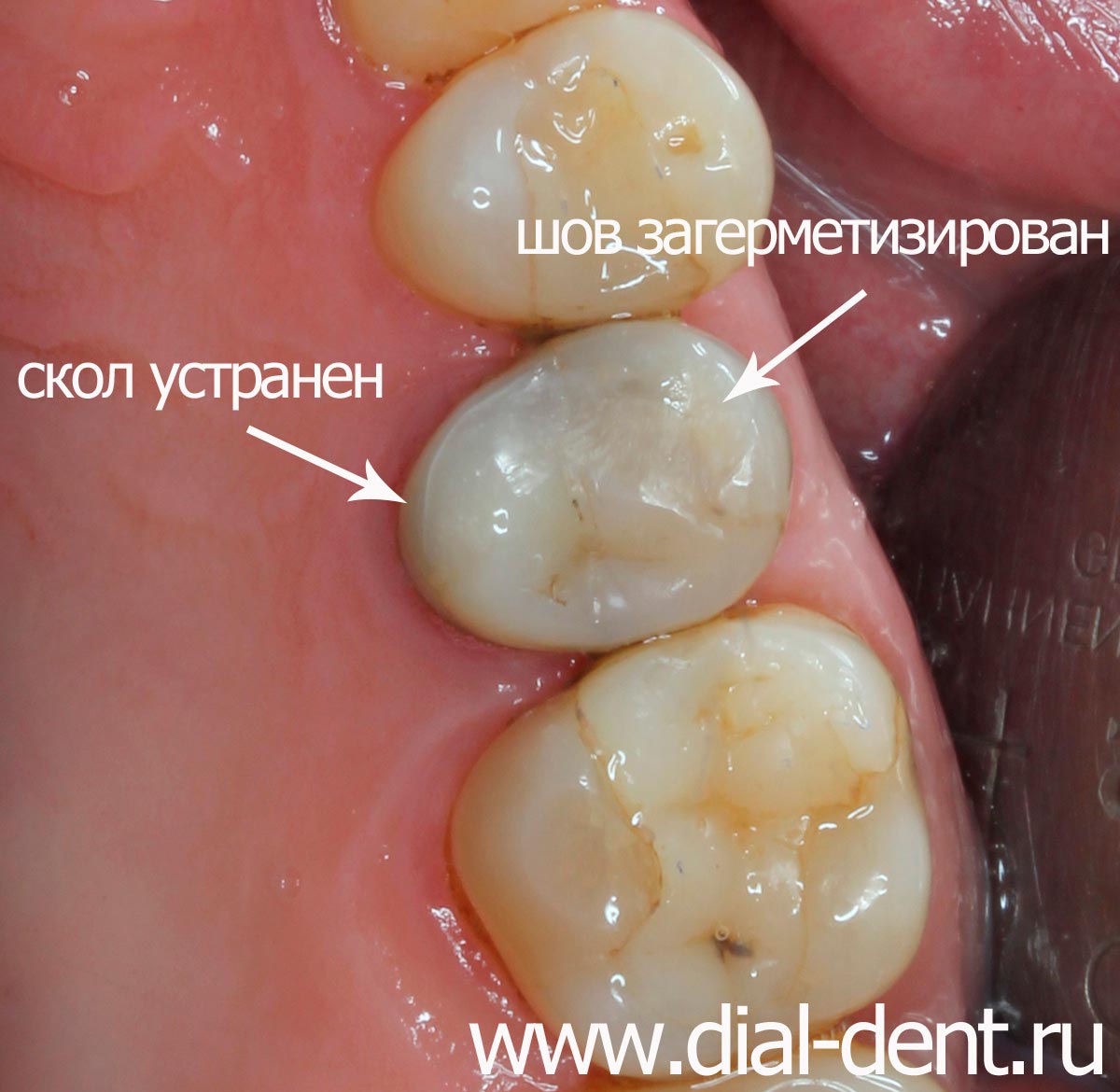 результат восстановления скола зуба