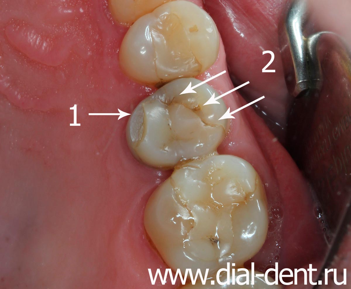 скол зуба, нарушение целостности шва старой реставрации через 12 лет
