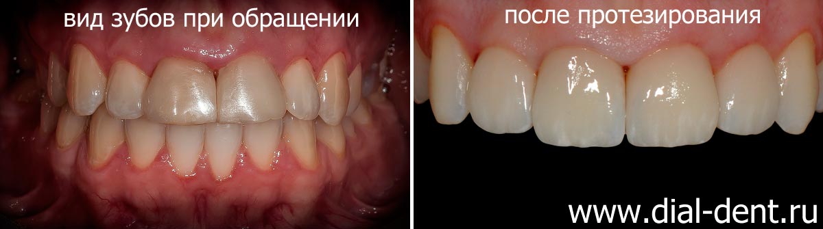 вид зубов до и после протезирования в Диал-Дент