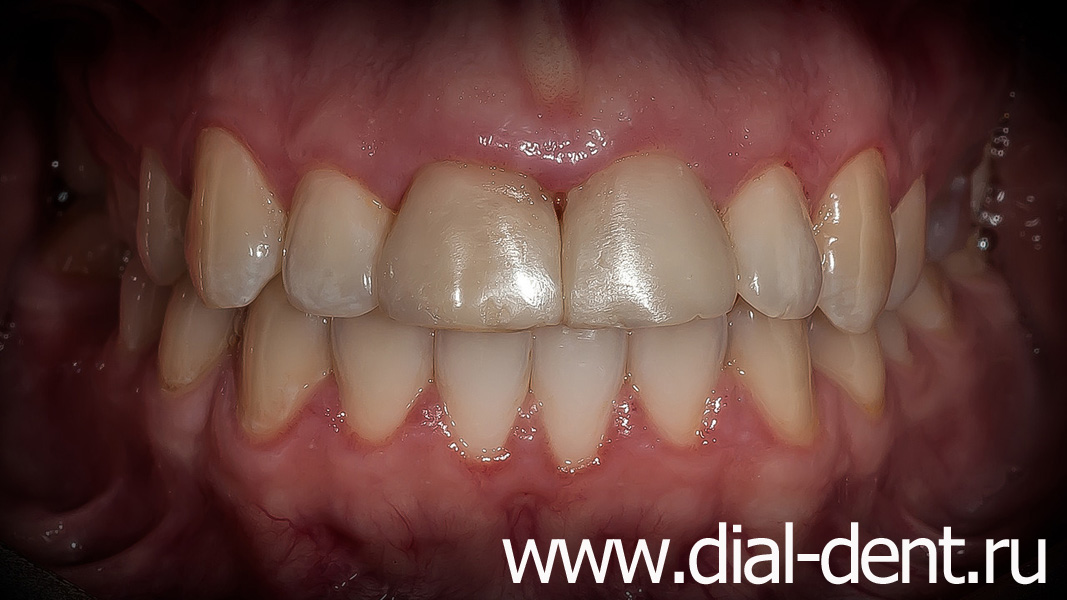 форма, цвет и размер передних зубов не удовлетворяют пациентку
