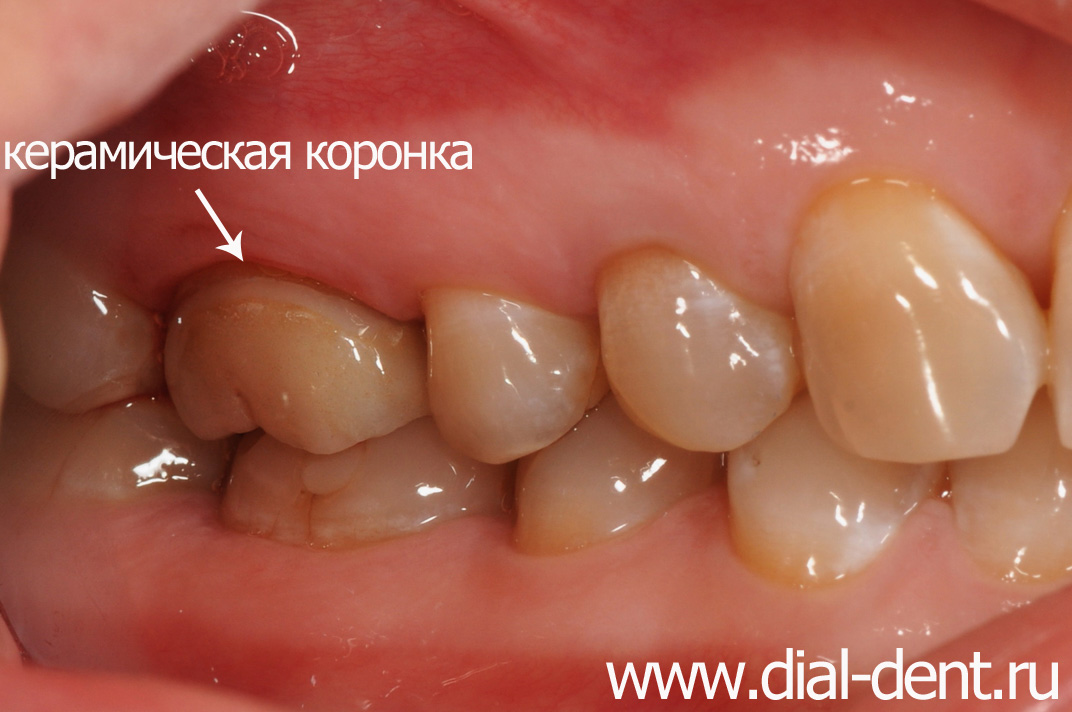 после лечения пульпита зуб закрыт керамической коронкой для прочности и восстановления формы