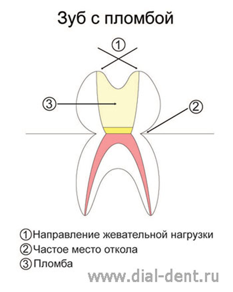 распределение нагрузки при реставрации зуба пломбой