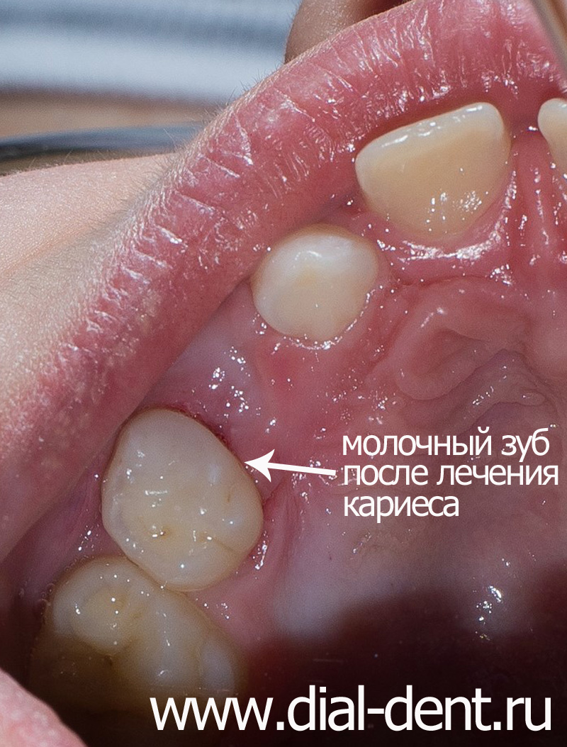 проведено лечение кариеса молочного зуба
