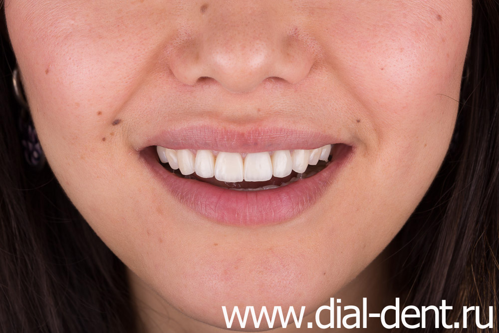 результат протезирования передних зубов в Диал-Дент