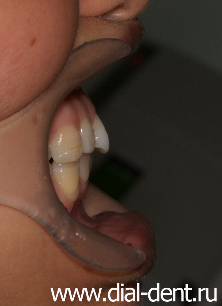 вид зубов сбоку до реставрации, передний зуб выступает