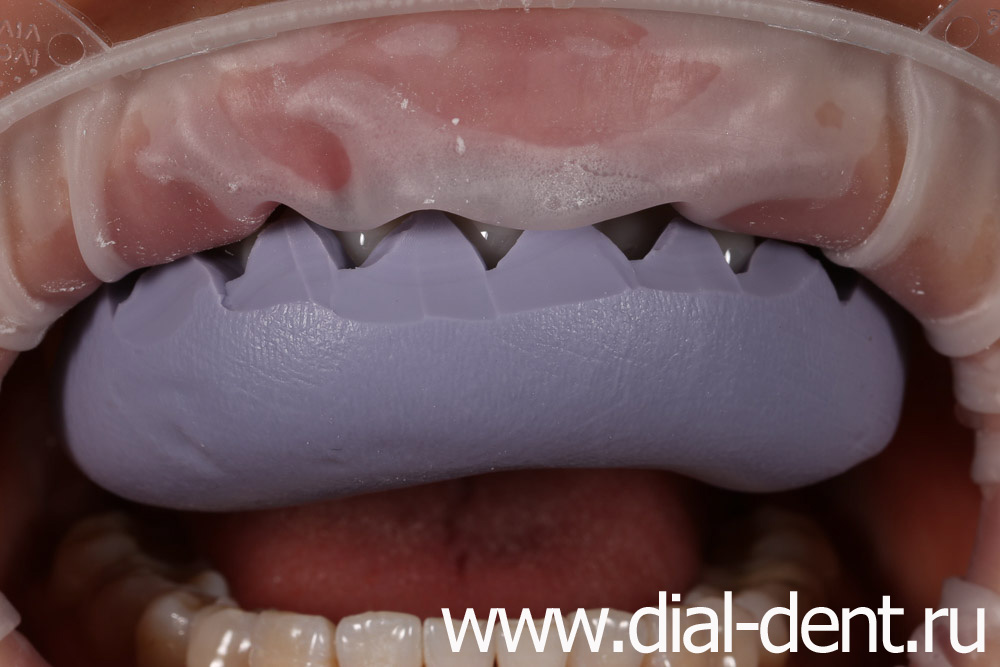 планирование протезирования передних зубов, перенос воскового моделирования на зубы
