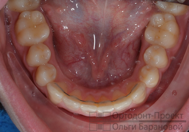 результат комплексного ортодонтического лечения