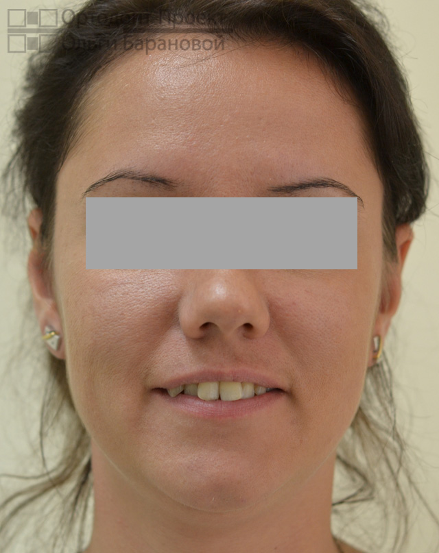 фотометрия до ортодонтического лечения