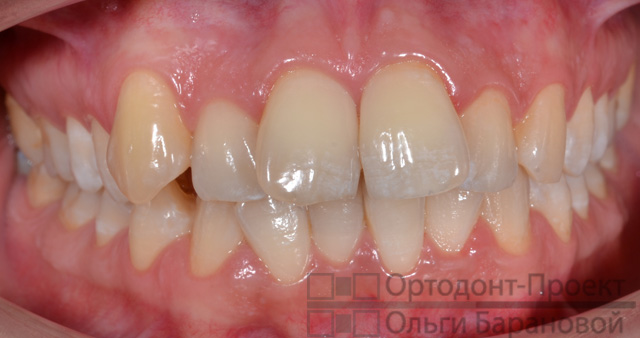 вид зубов до ортодонтического лечения