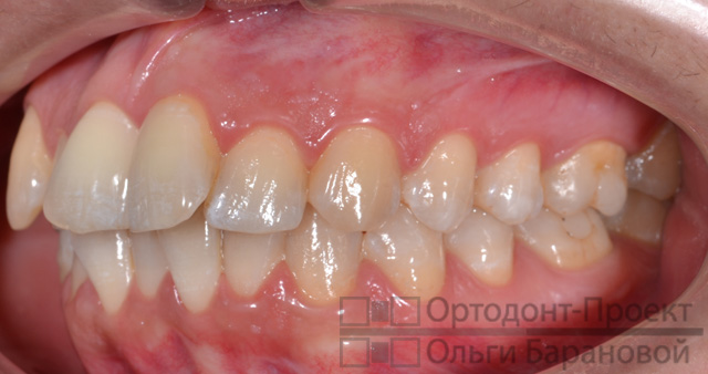 вид слева до ортодонтического лечения