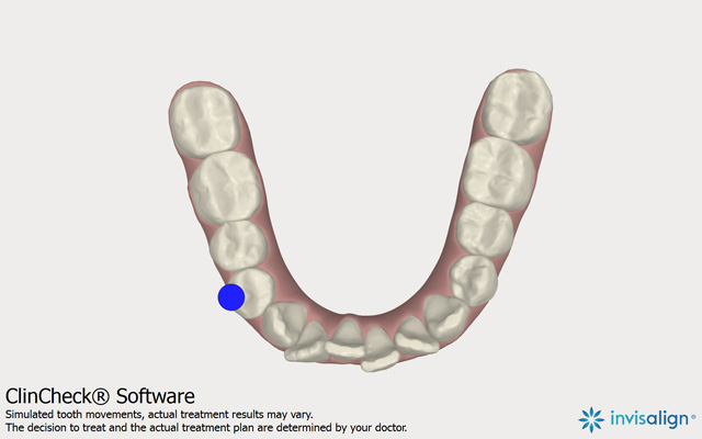 модель исходного состояния нижних зубов