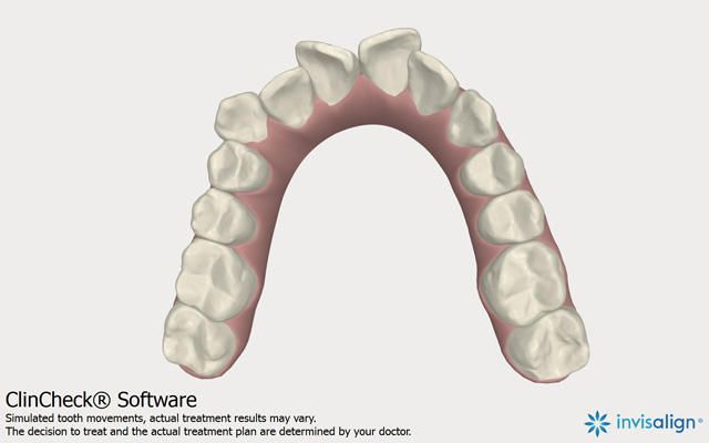 модель исходного положения верхних зубов