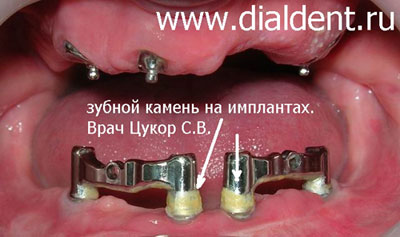зубной камень на имплантах