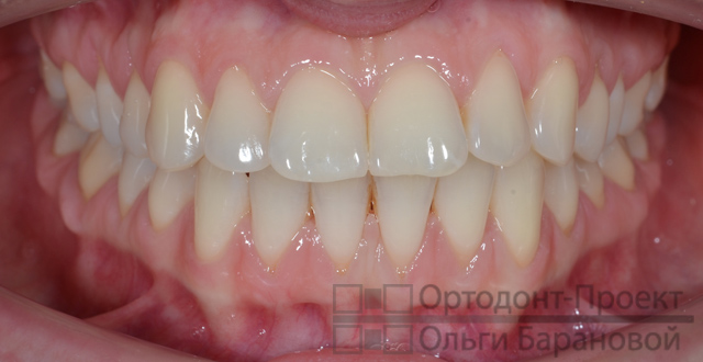 вид зубов спереди до ортодонтического лечения