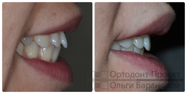 вид зубов в профиль до и после лечения у ортодонта