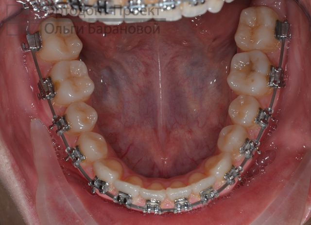 нижние зубы с металлическими брекетами