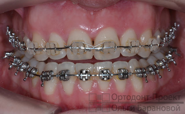 вид зубов в процессе ортодонтического лечения