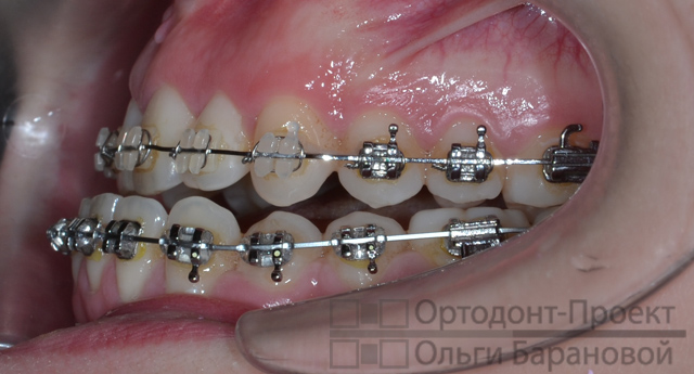 вид зубов слева в процессе ортодонтического лечения