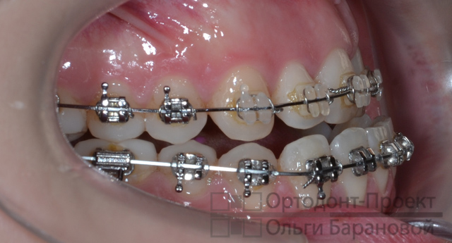 вид зубов справа в процессе ортодонтического лечения