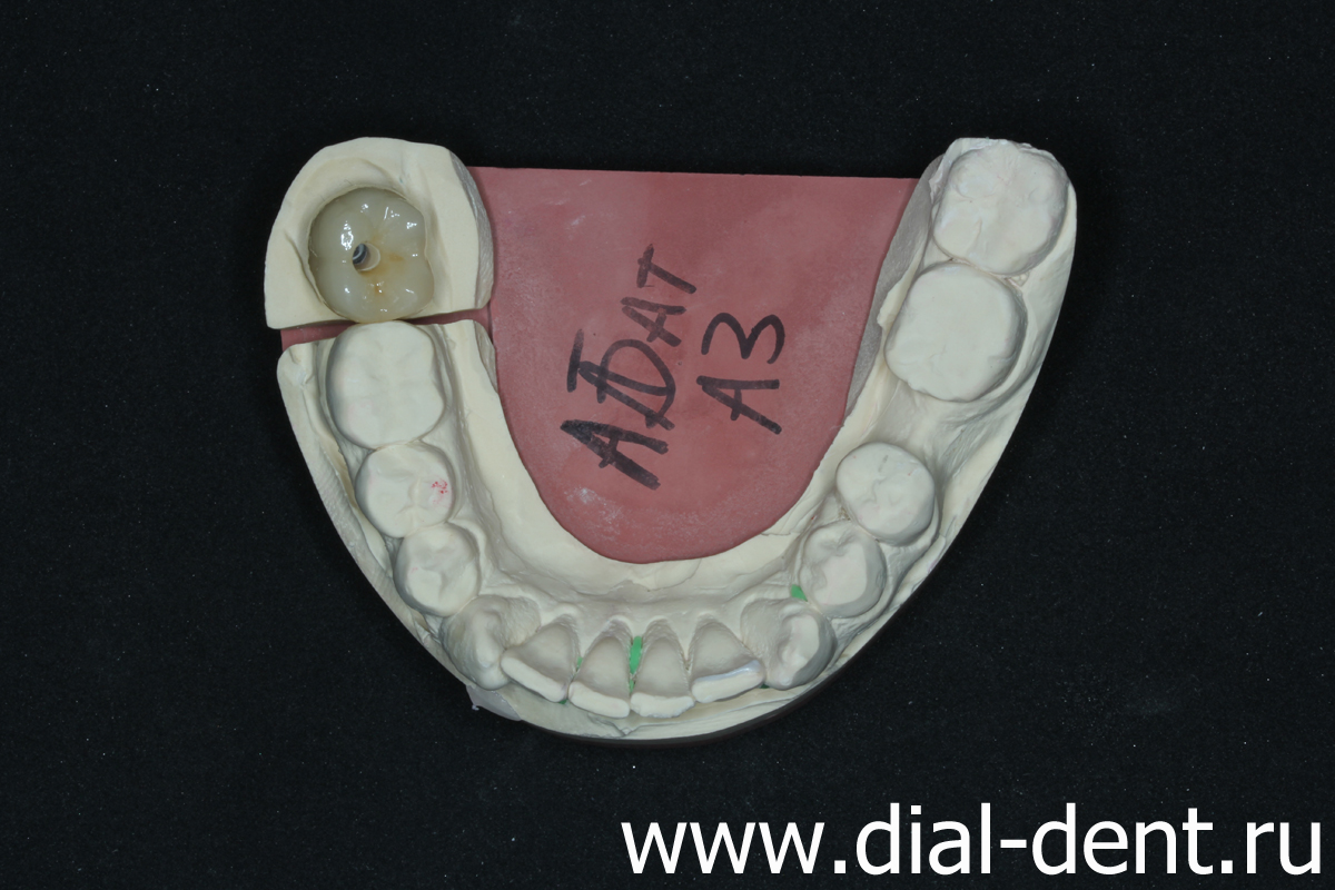 протезирование зуба на импланте, лаборатория Диал-Дент