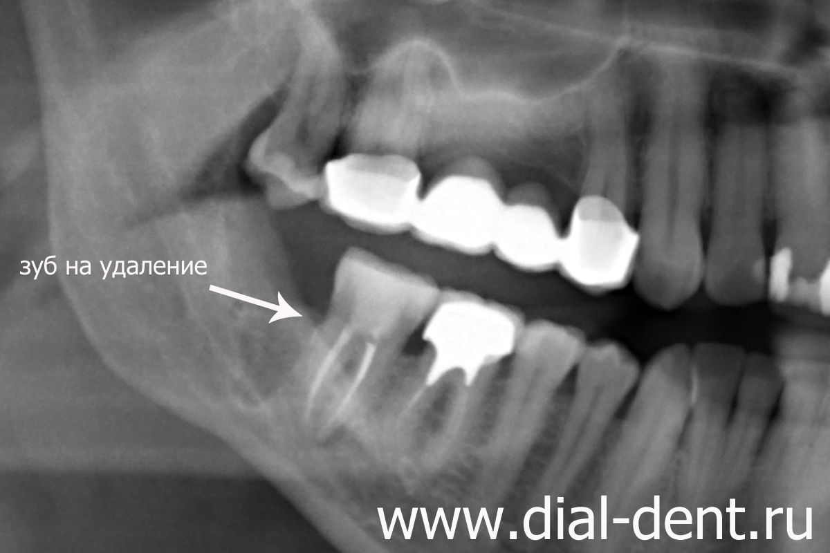 панорамный снимок зубов до удаления и имплантации зуба