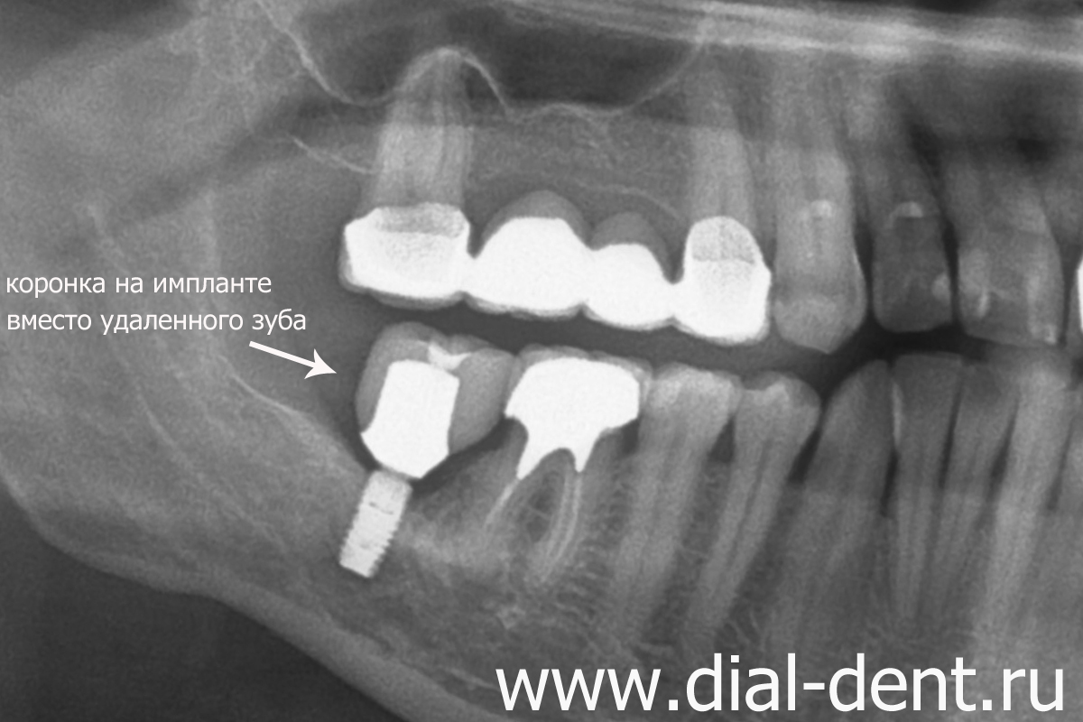 панорамный снимок зубов после имплантации и приживления импланта