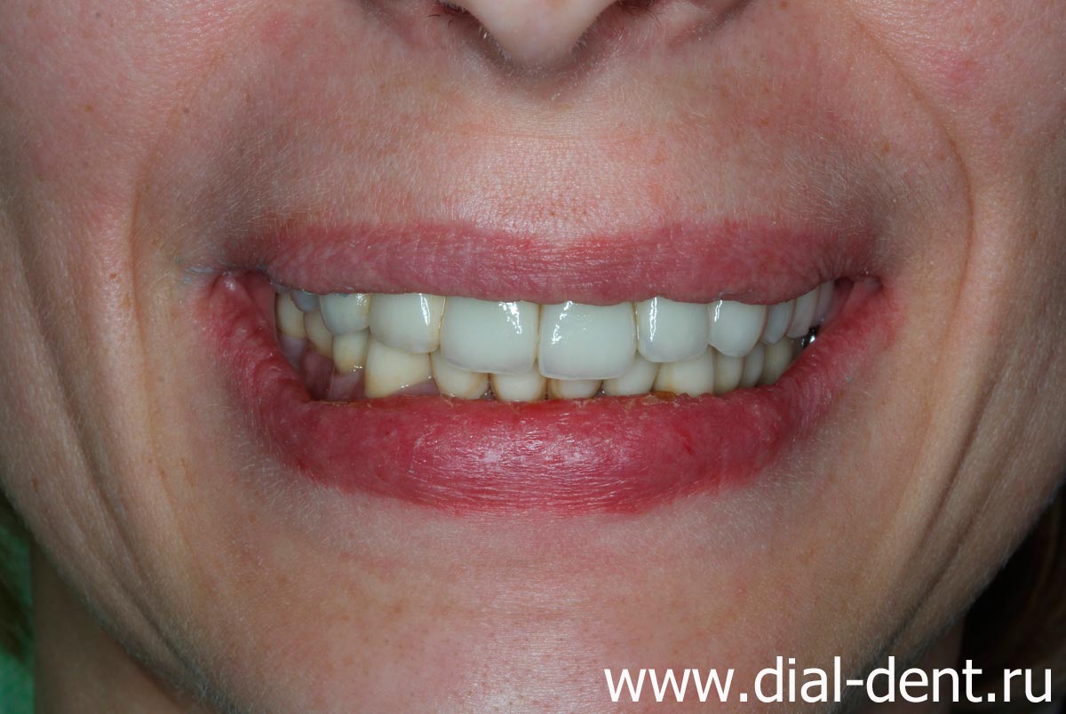 после комплексного лечения и протезирования зубов в Диал-Дент