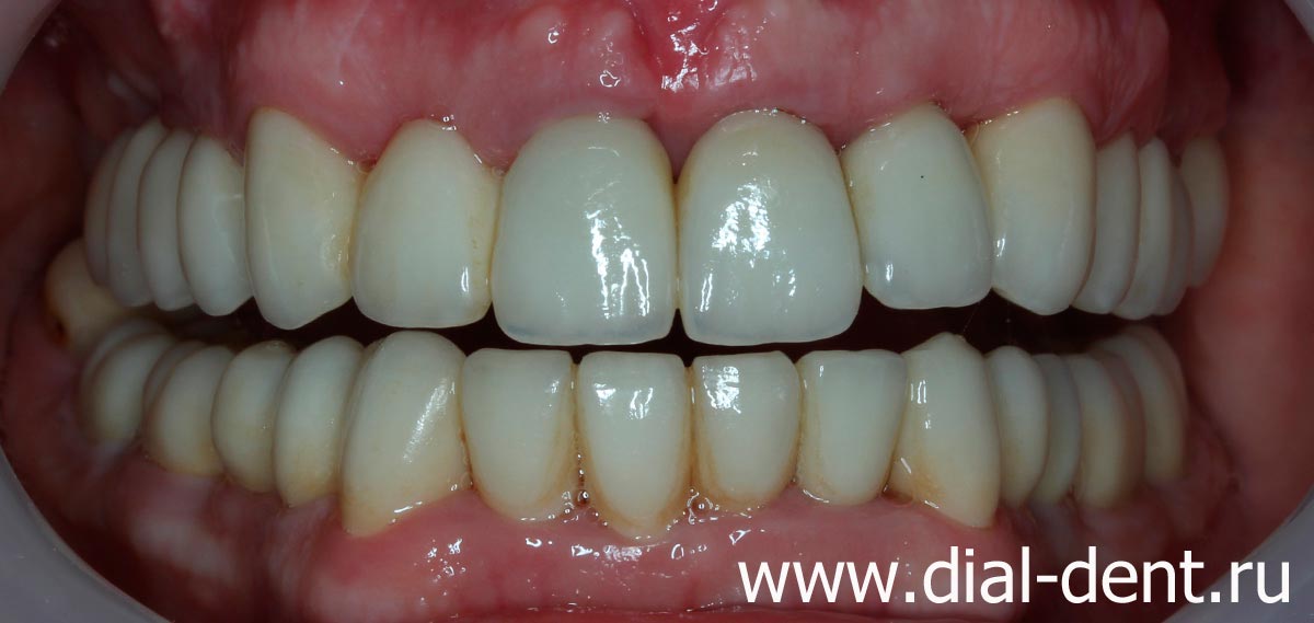 после комплексного лечения и протезирования зубов в Диал-Дент