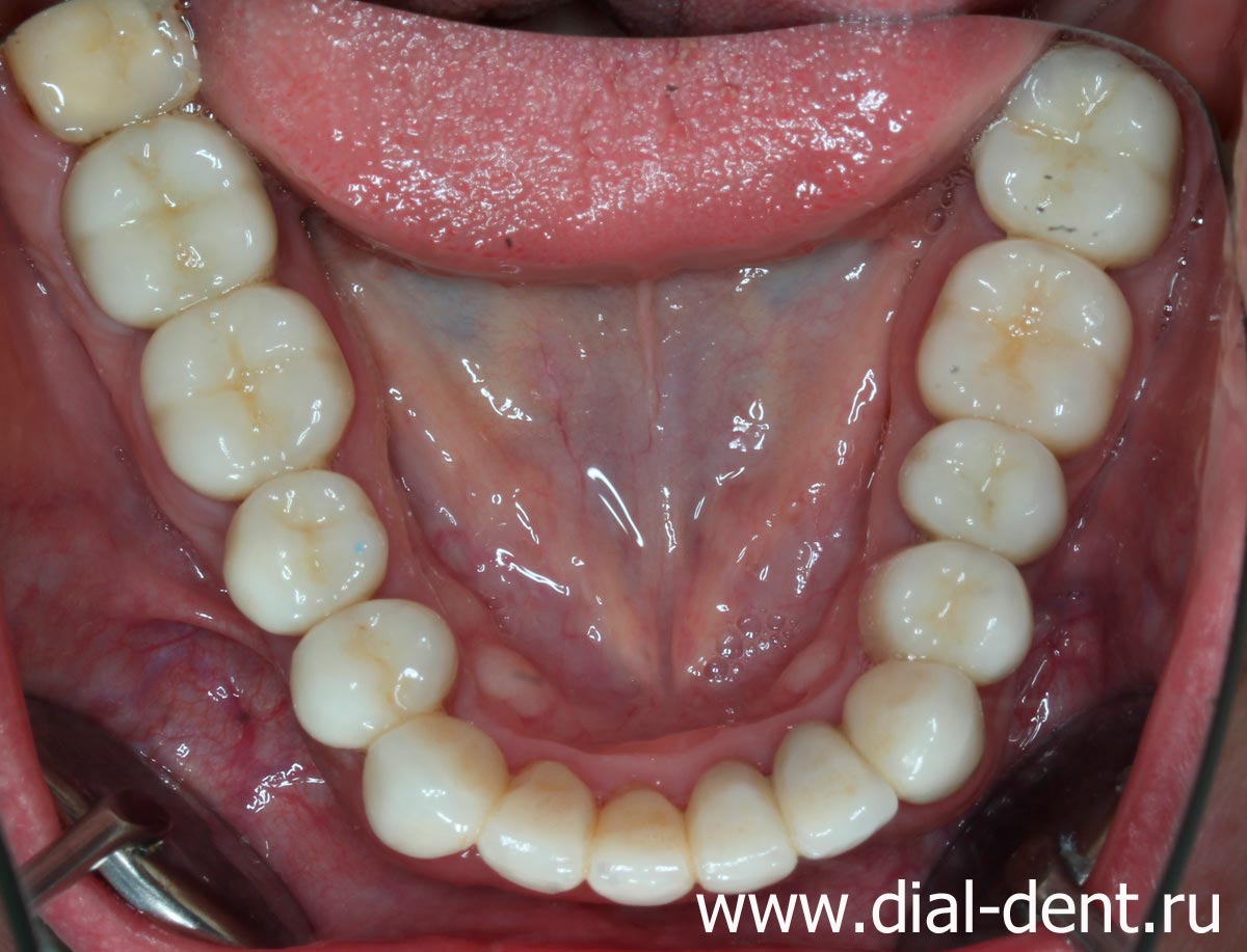 нижние зубы после комплексного лечения и протезирования зубов в Диал-Дент