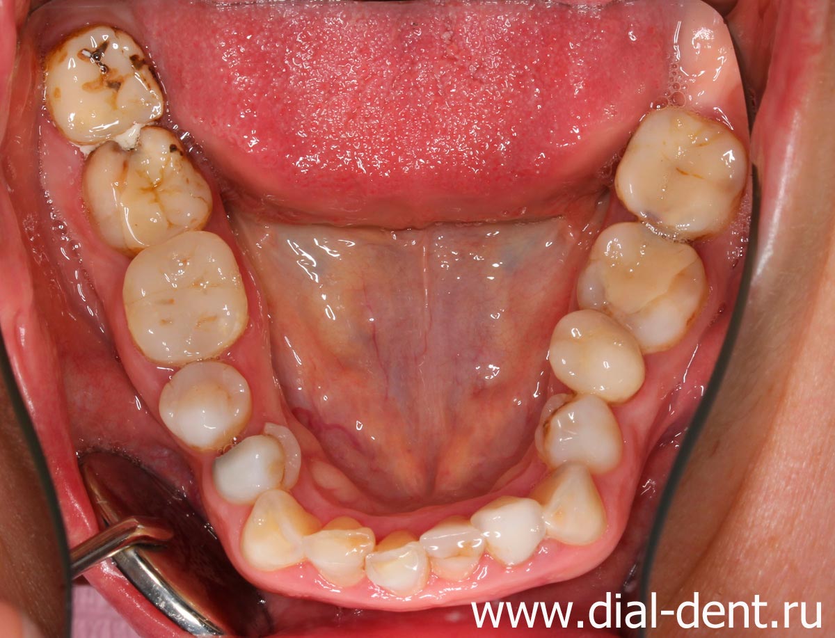 нижние зубы до лечения, старые пломбы, кариес, повышенная стираемость эмали