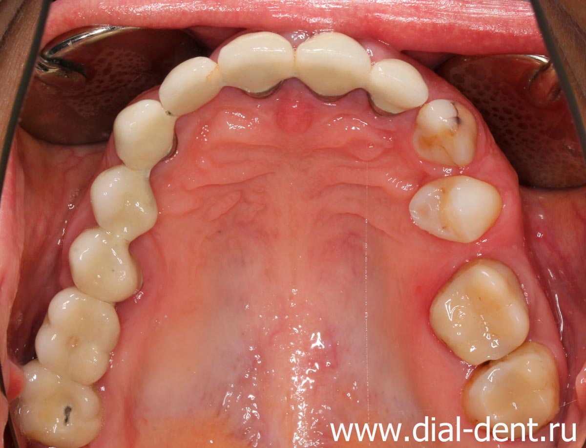 верхние зубы до лечения, протяженный мостовидный протез