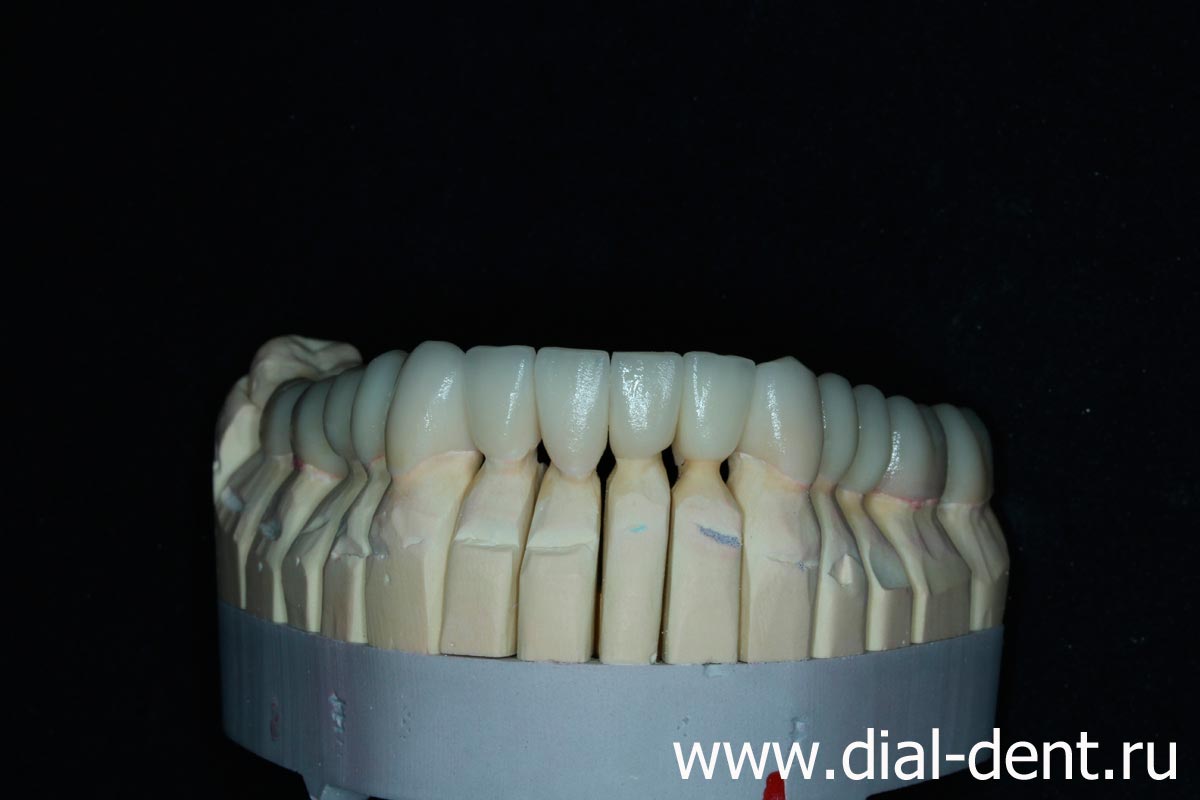 керамические реставрации нижних зубов на модели