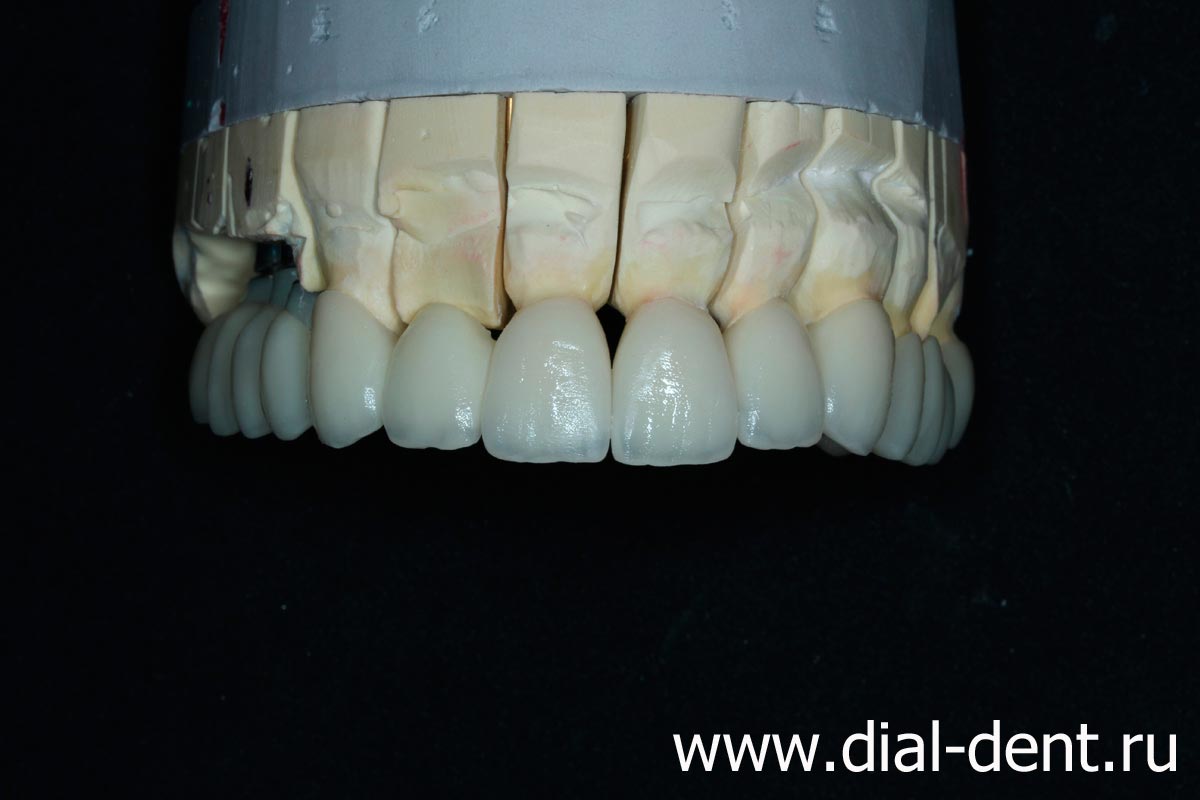керамические реставрации верхних зубов на модели
