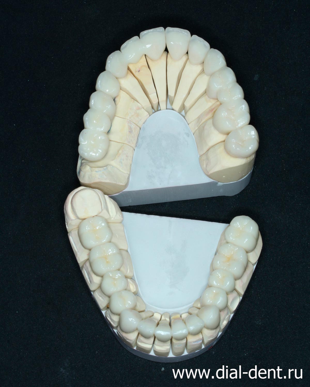 керамические реставрации зубов на модели
