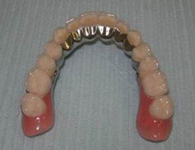 зубной протез с опорой на импланты