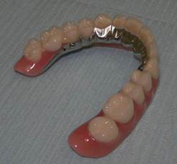зубные протезы с опорой а имплантах