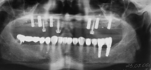 имплантация зубов при полном отсутствии зубов в челюсти